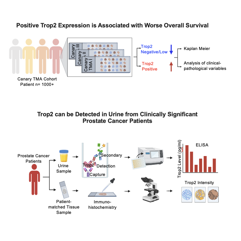 High expression of Trop2 is associated with aggressive localized prostate cancer and is a candidate urinary biomarker