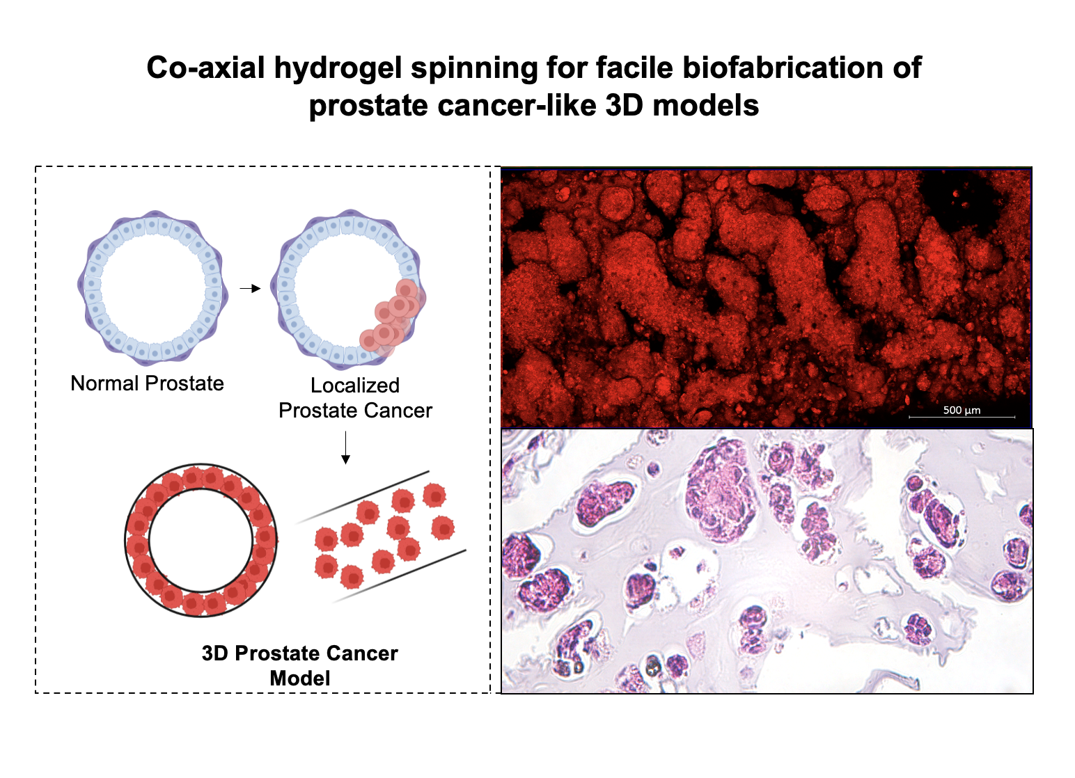 Co-axial hydrogel spinning can construct facile biofabrication of prostate cancer-like 3D models