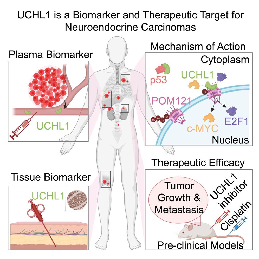 UCHL1 is a potential molecular indicator and therapeutic target for neuroendocrine carcinomas